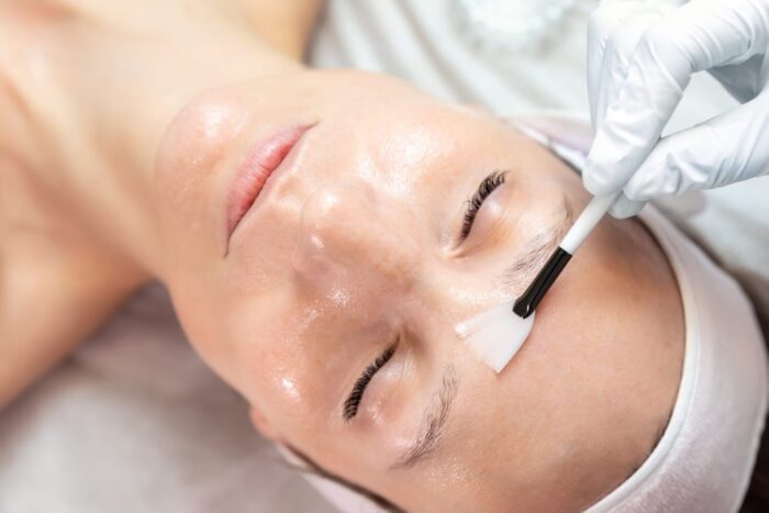 Types of Chemical Peels