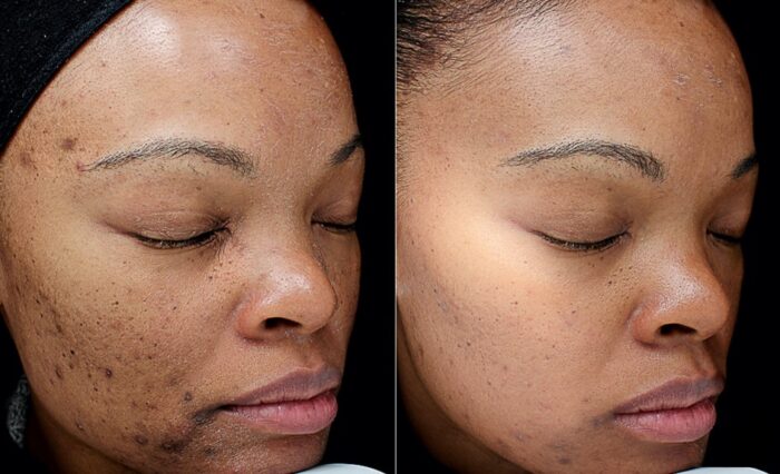 hyperpigmentation chemical peel before and after