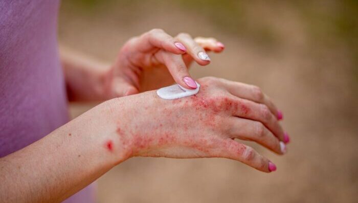 Managing Eczema Flare-Ups Holistically